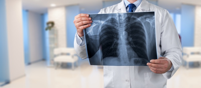 Doctor looking chest x-ray